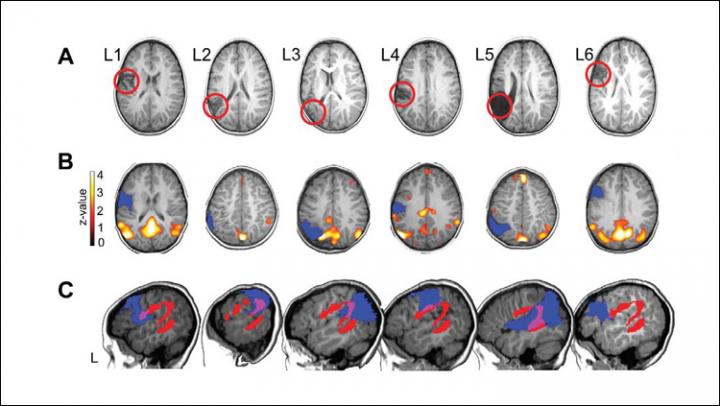 Brain Reorganization Predicts Language Production