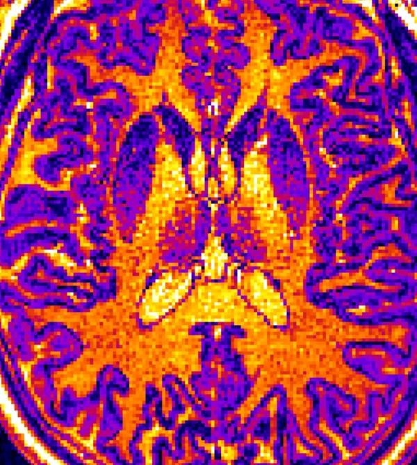 Magnetic Resonance Imaging Image of An Adult Human Brain