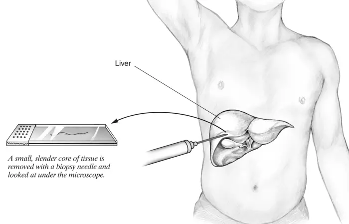 Liver Biopsy