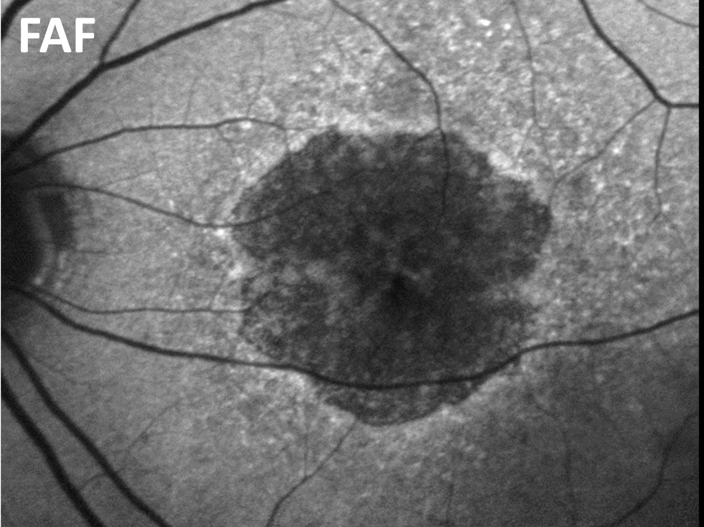 Fundus autofluorescence (FAF):