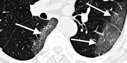 CT scan of lungs of COVID-19 patient