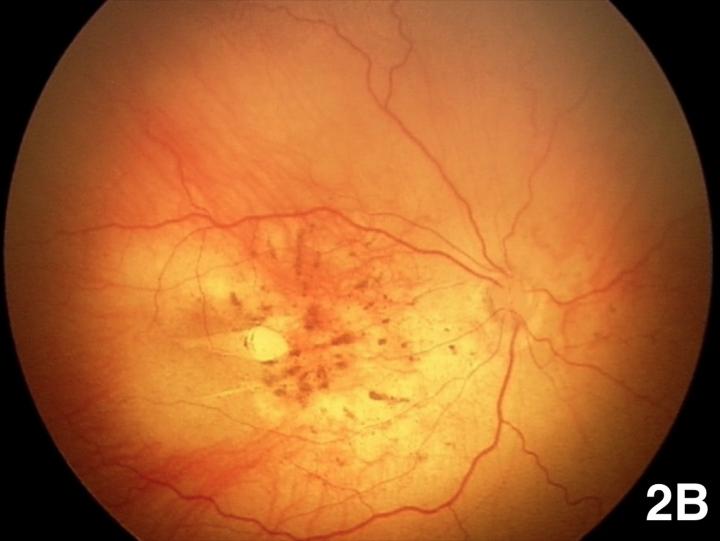 Macular Lesion in Baby with Zika-Induced Microcephaly