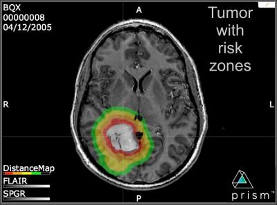 MRI Brain Image