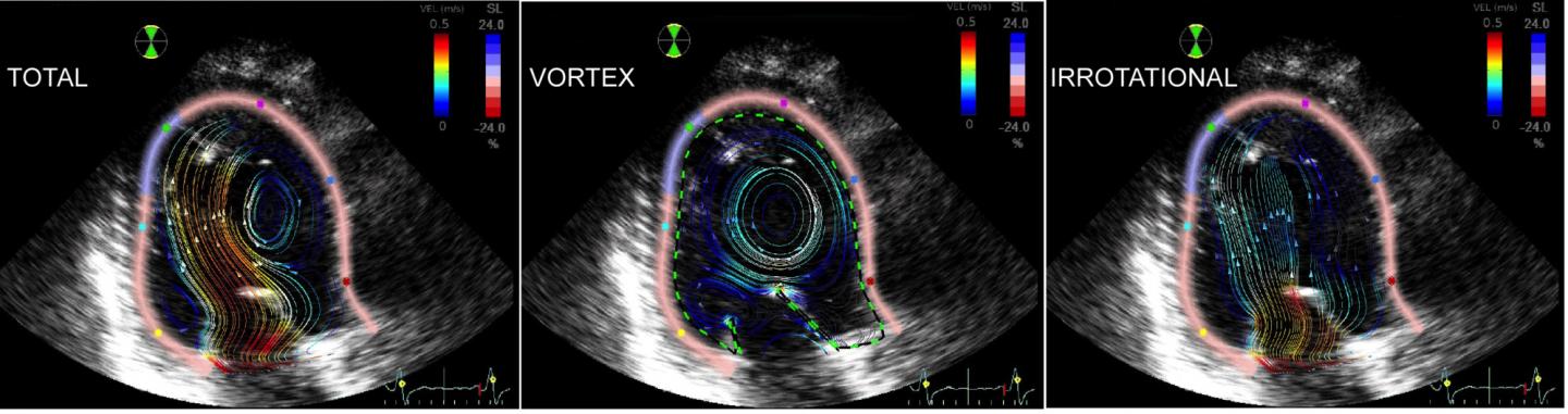 2-D-Velocity Field Separation for Intra-Ventricular Blood Flow