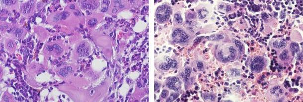 Tracking Blood Cancer