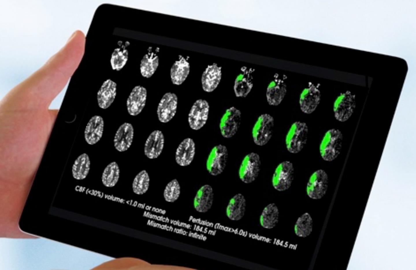 Brain-Scan Guided Emergency Stroke Treatment Can Save More Lives