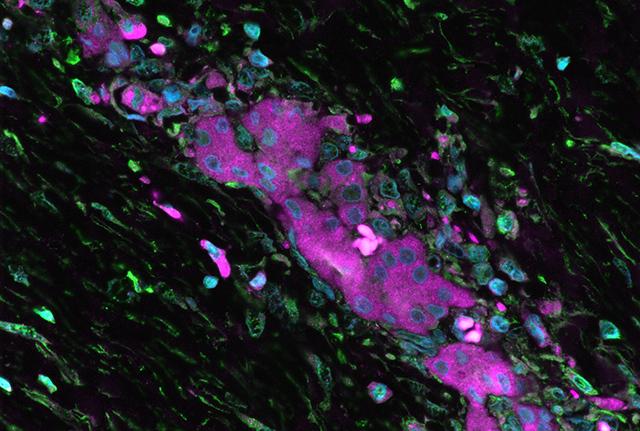 Liver Tumor Cells from  Fibrolamellar Carcinoma Patient