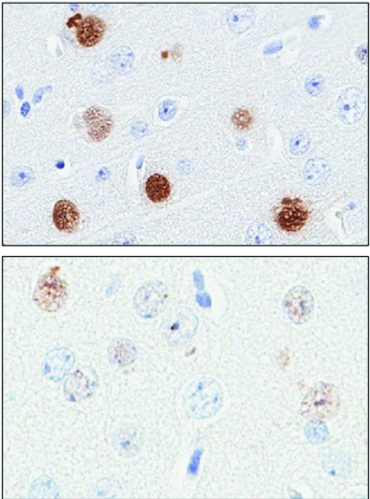 A New Marker for the Most Common Form of ALS