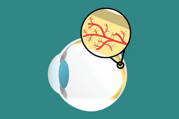 Macular Degeneration Illustration