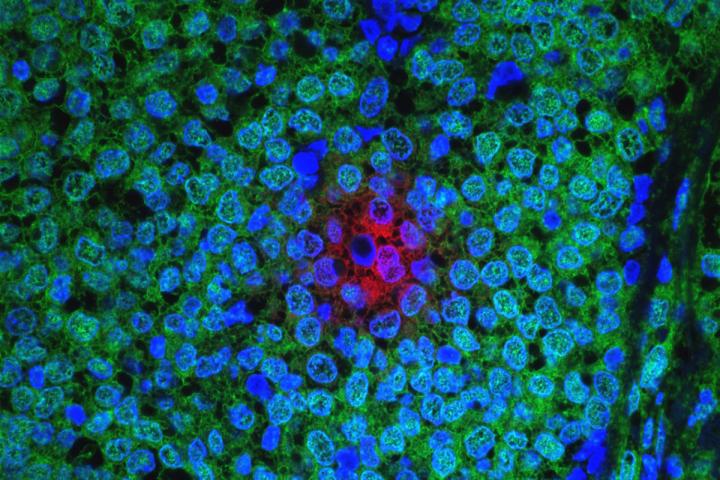 Breast cancer tumor, NCI