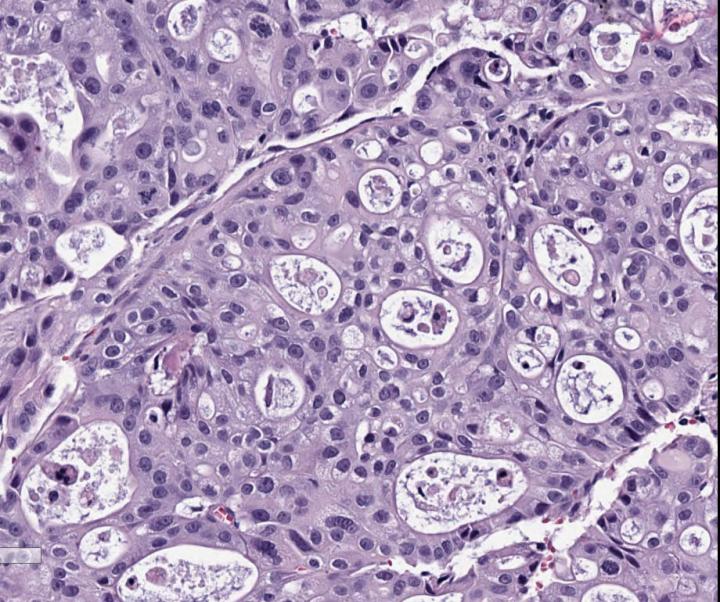 Patient-Derived Pancreatic Tumor
