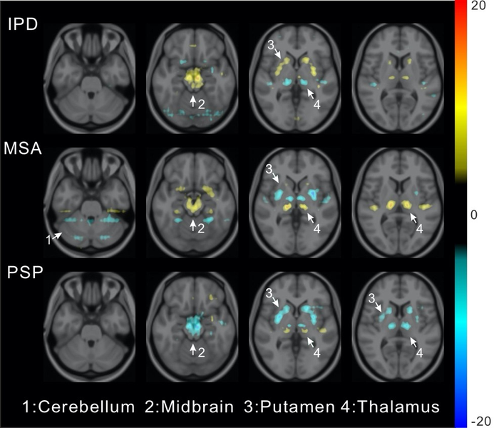 Visualization of average saliency maps of patients with parkinsonian diseases.