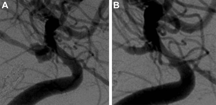 Novel Treatment Effective for Sidewall Brain Aneurysm