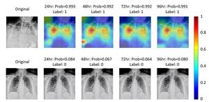 The proposed deep learning model utilizes chest x-ray radiography images to predict if a patient with COVID-19 will need intensive care within 24, 48, 72, and 96 hours after examination.