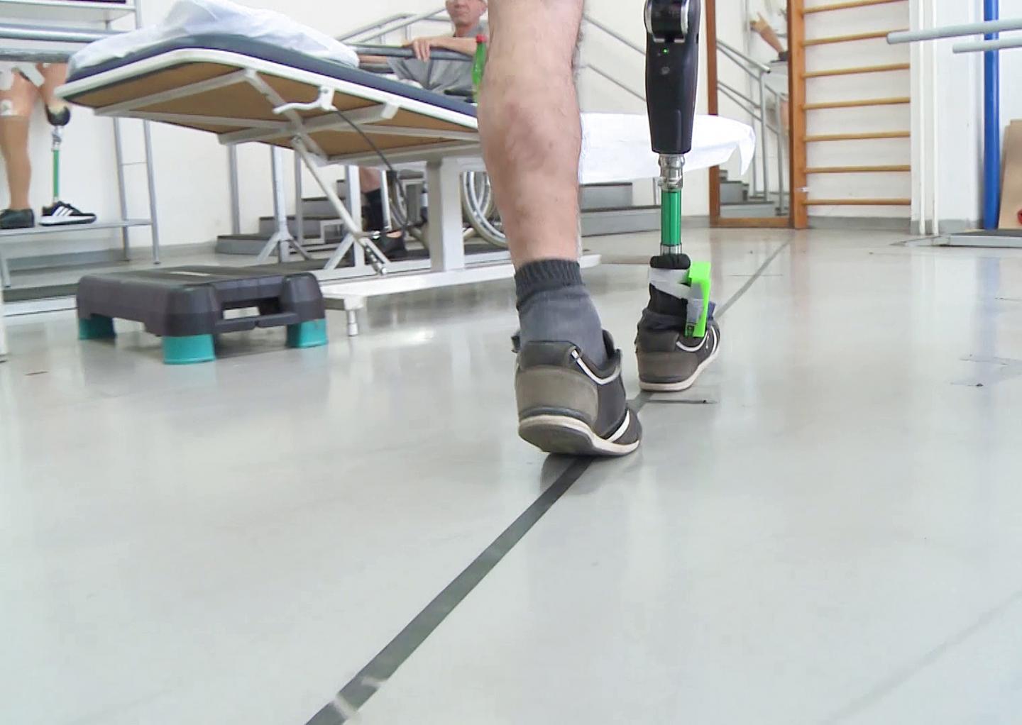 Nerve-Stimulating Leg Prosthesis Improves Movement and Functionality in Amputees (3 of 10)
