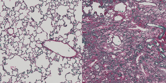 Healthy and fibrotic lung tissue