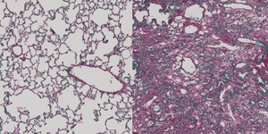 Healthy and fibrotic lung tissue