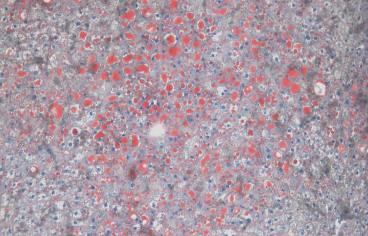 Fat Staining in the Liver