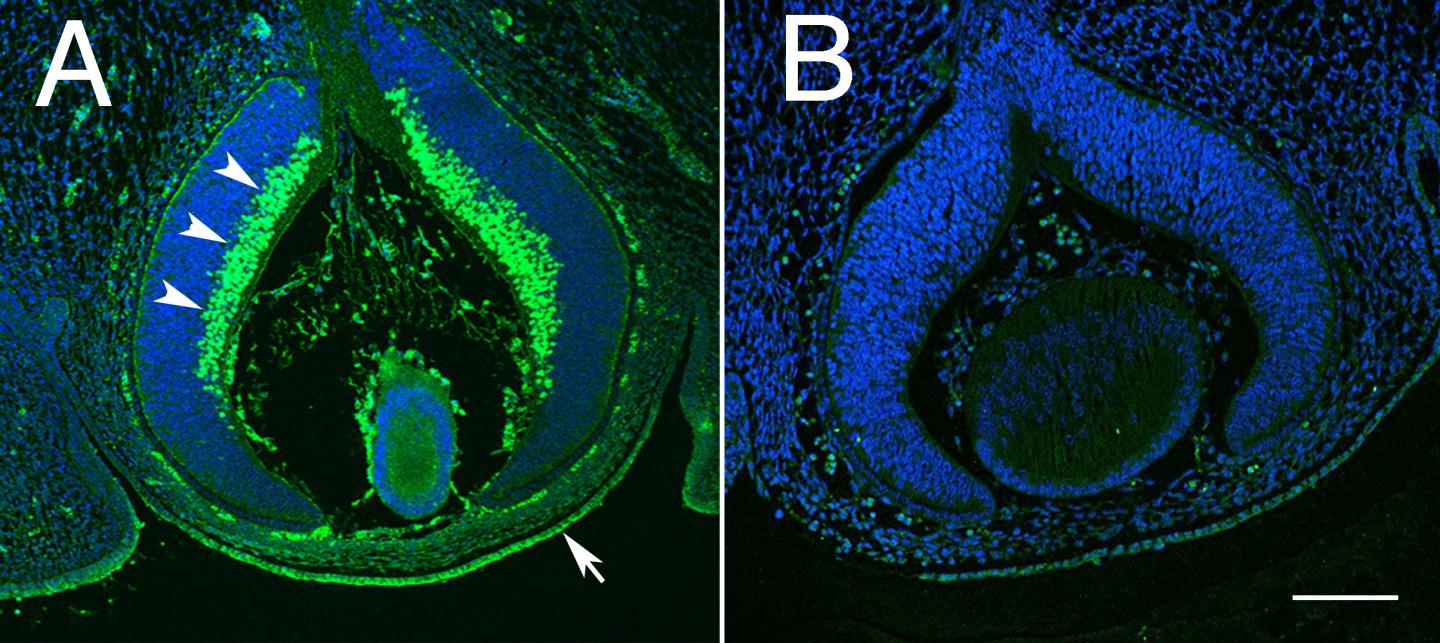 Study finds genetic link between thinner corneas and increased risk of glaucoma