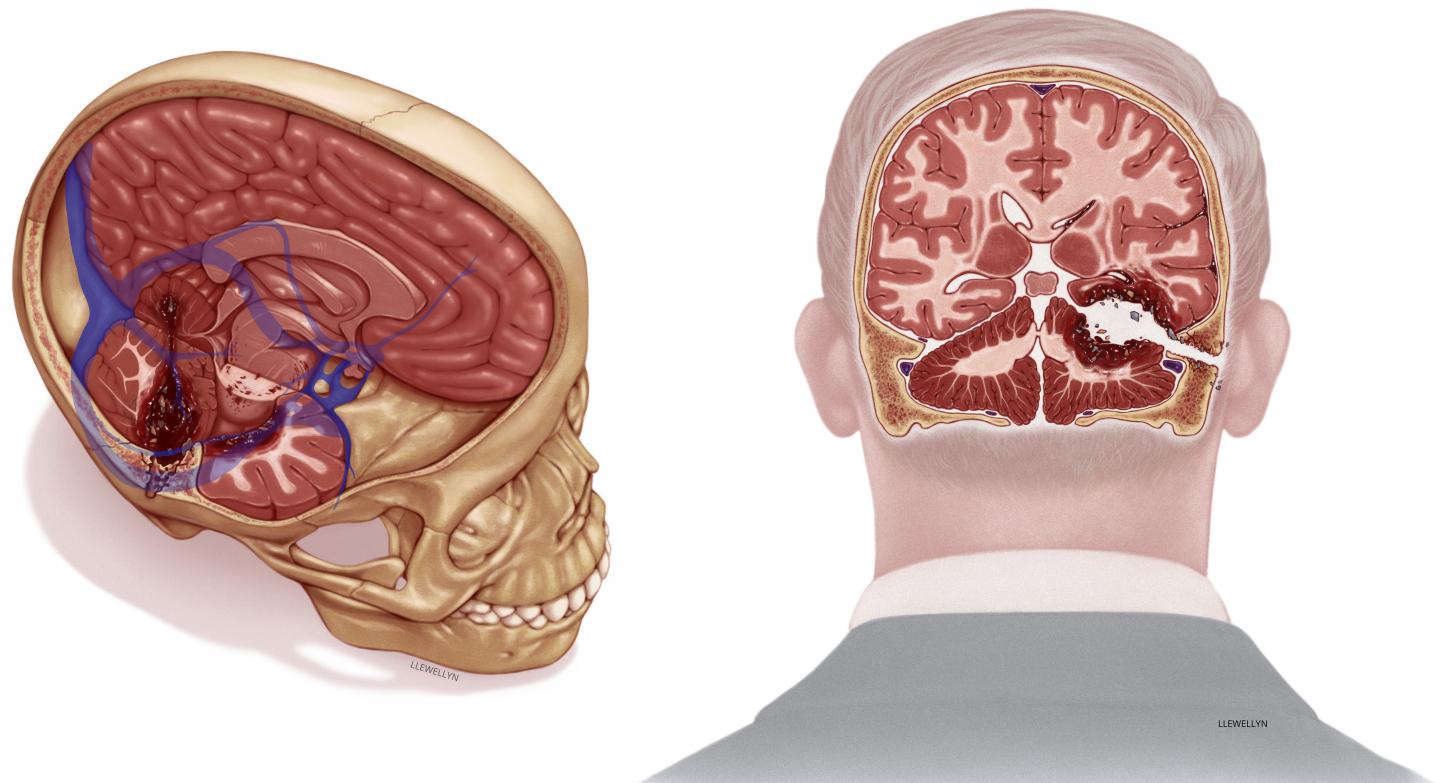 Artist's Representation of Robert F. Kennedy's Injuries