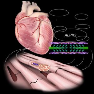 A new therapeutic target for a lethal form of heart failure: ALPK2