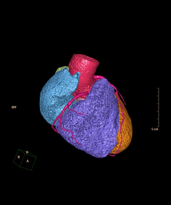 CTA Coronary artery 3D rendering image for detect coronary artery disease.