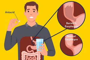 Barrett's esophagus