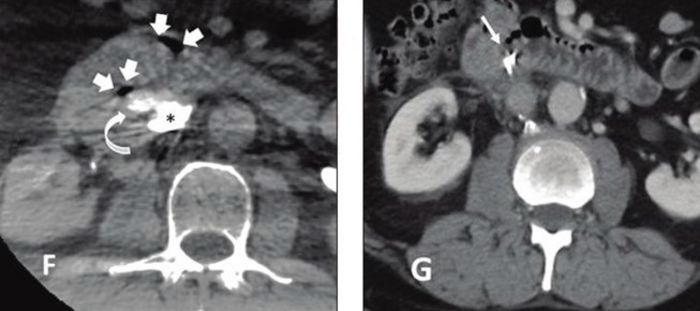 58-year-old patient referred for complex IVC filter retrieval after dwell time of 72 months