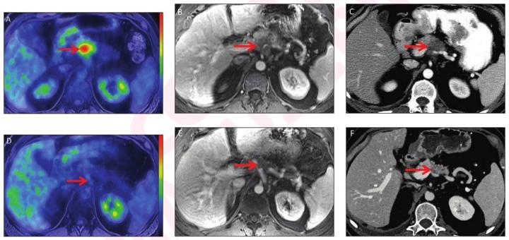 Pet Mri Ct Metrics Assess Pat Eurekalert Science News Releases