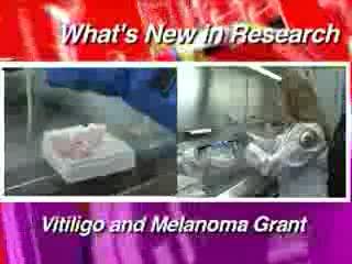 Vitiligo and Melanoma Research