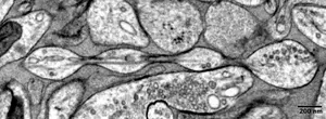 Micrograph image of the "pearling" structure of an axon