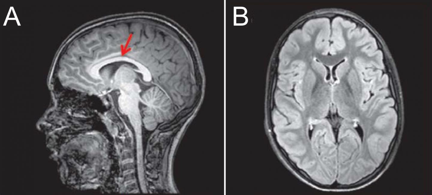 Mutation Underlying Motor Neuropathy Uncovered (1 of 2)