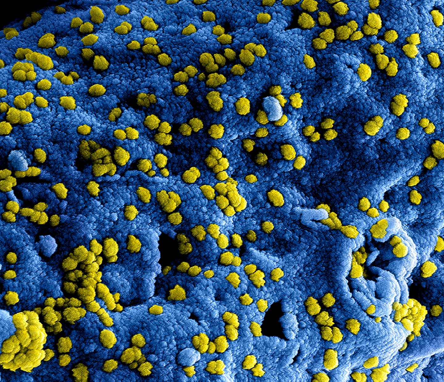 MERS Virus Particles Attached to the Surface of An Infected Cell.