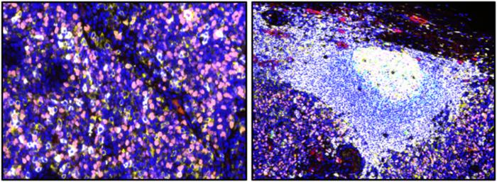 Scientists Identify a New Cancer Immunotherapy Target: Dysfunctional B Cells