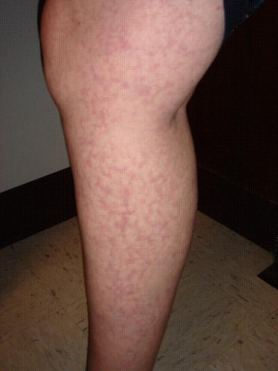 Leg with Livedo Reticularis