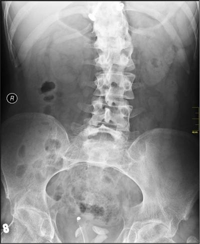 Scoliosis