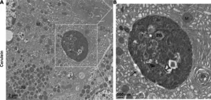 Electron microscopy photographs of a large vacuole in acute pancreatitis tissues.