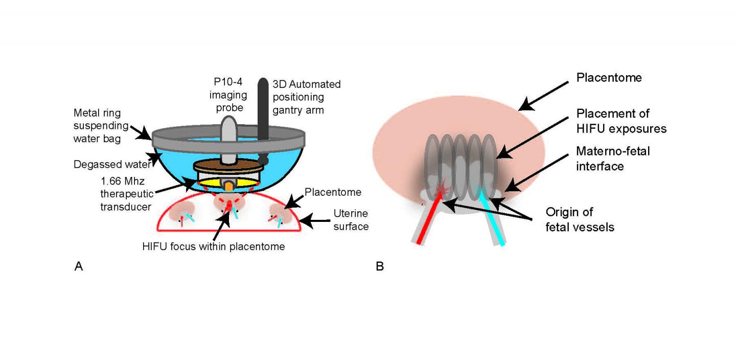Ultrasound Offers Tool for Blocking Faulty Vessels in Placental Disorder