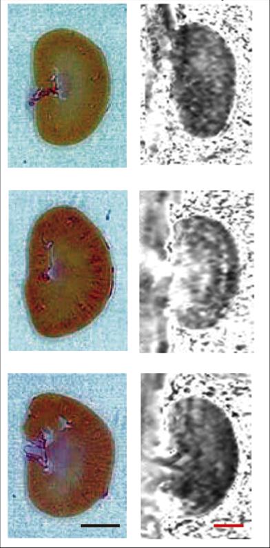 Figure 1. Visualization of Renal Fibrosis in Fractional Anisotropy