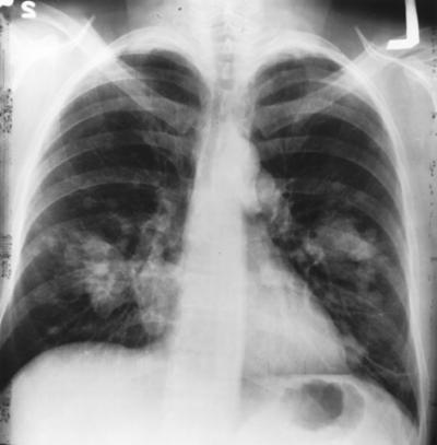 Chest X-ray, Lung Cancer