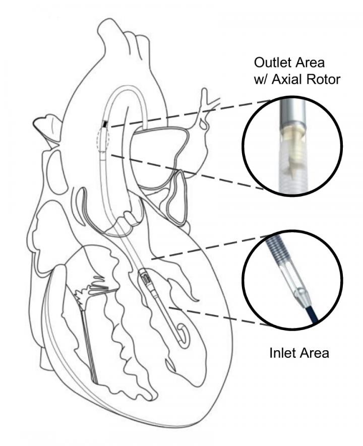 Implantable Machines Measure Heart Function (1 of 2)