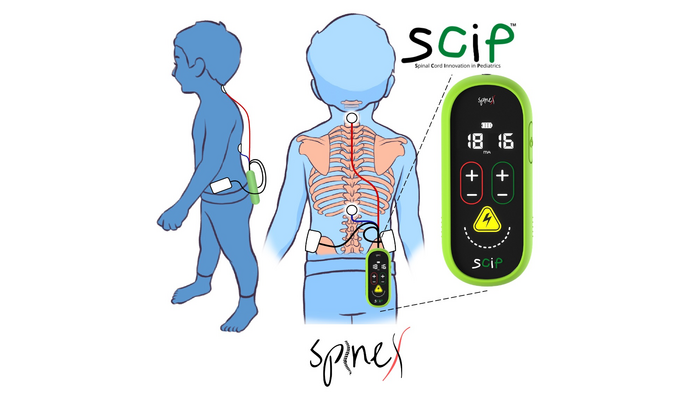 Non-Invasive Device SCiP to Treat children with Cerebral Palsy: A parents perspective