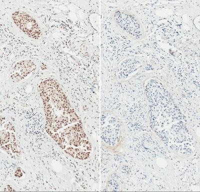 Protein Preps Cells to Survive Stress of Cancer Growth and Chemotherapy