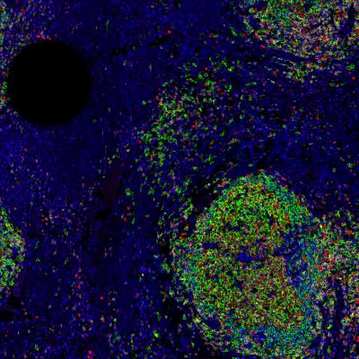 Chromosomal Clues to Cancer Survival (1 of 2)