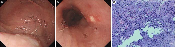 Histopathological examination of the biopsy specimens revealed high-grade intraepithelial neoplasia