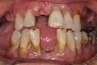 Severe Gum Disease