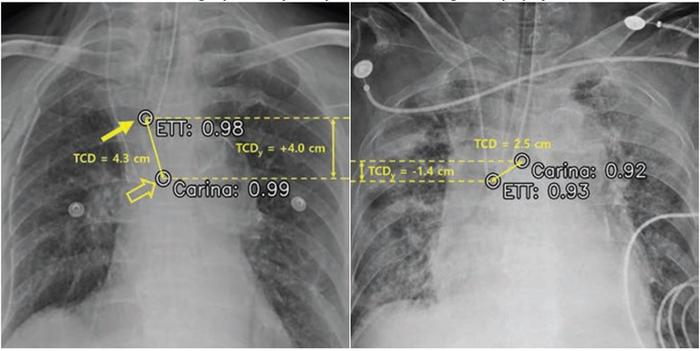 Chest radiograph analysis by AI system