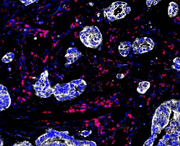 Cancer cells and macrophage immune cells