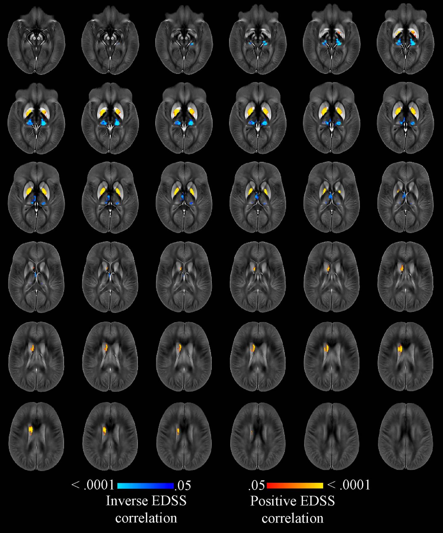 Quantitative Susceptibility Maps w/in Thalamus, Caudate, Globus Pallidus, & Putamen (3 of 3)