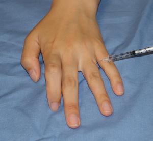 Picture of the hand from the study